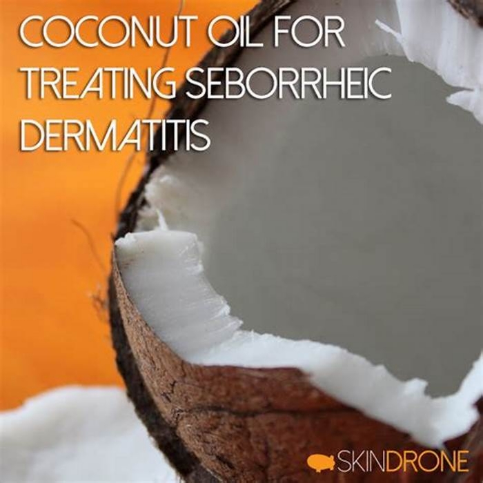 Can coconut oil help with seborrheic dermatitis