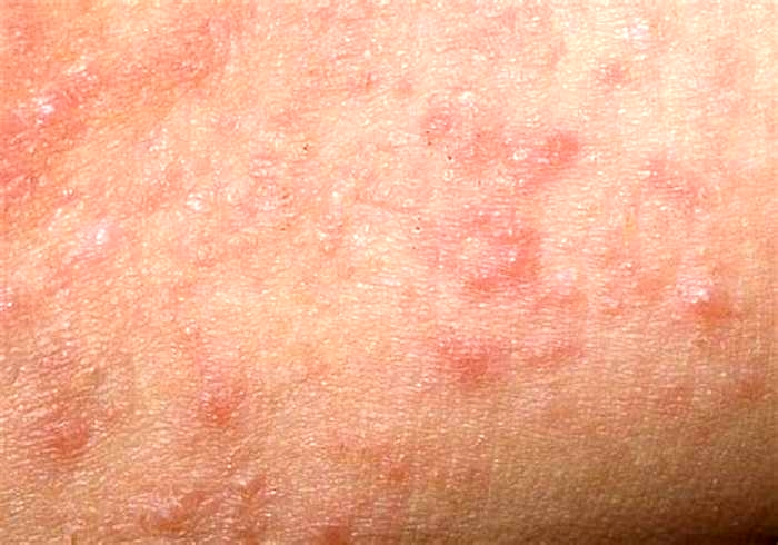 Do groin rashes go away on their own?