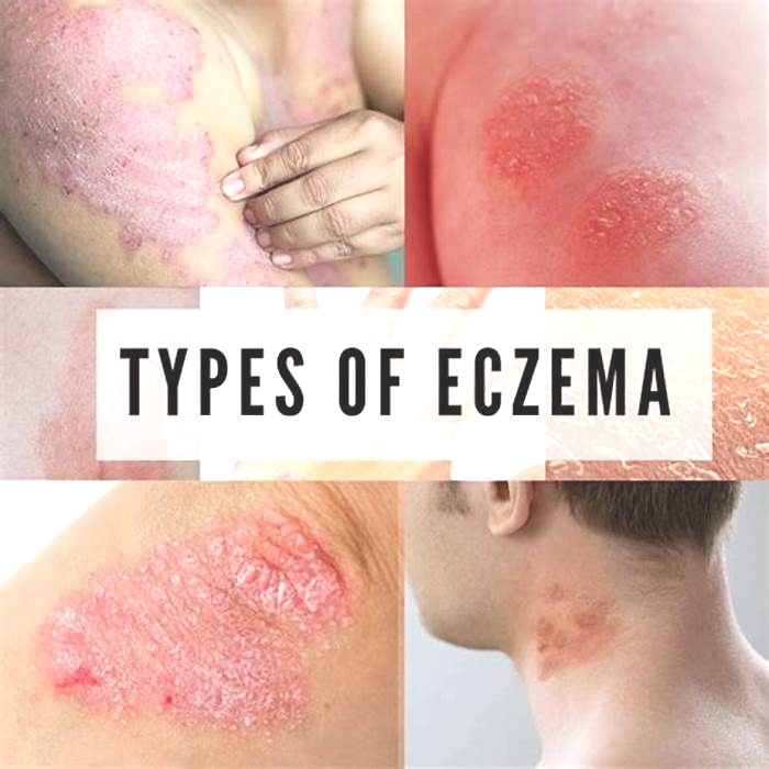 How do I know if it's eczema or fungus?