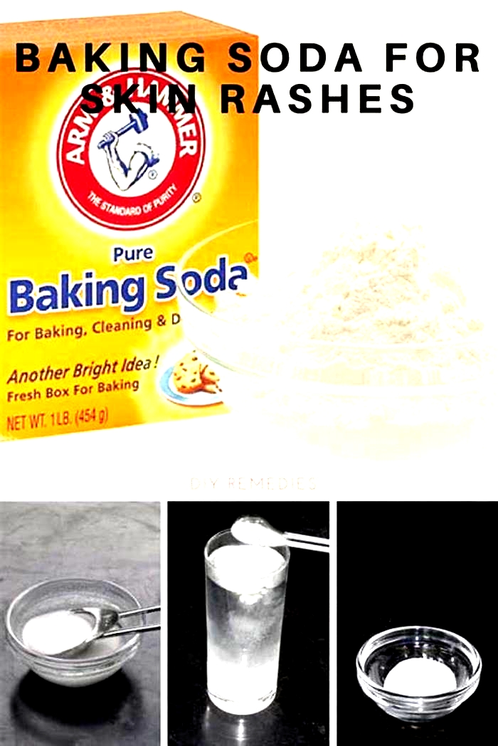 How does baking soda help itching?