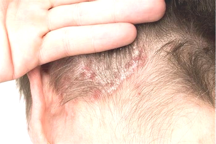 How long does it take for seborrheic dermatitis to go away?