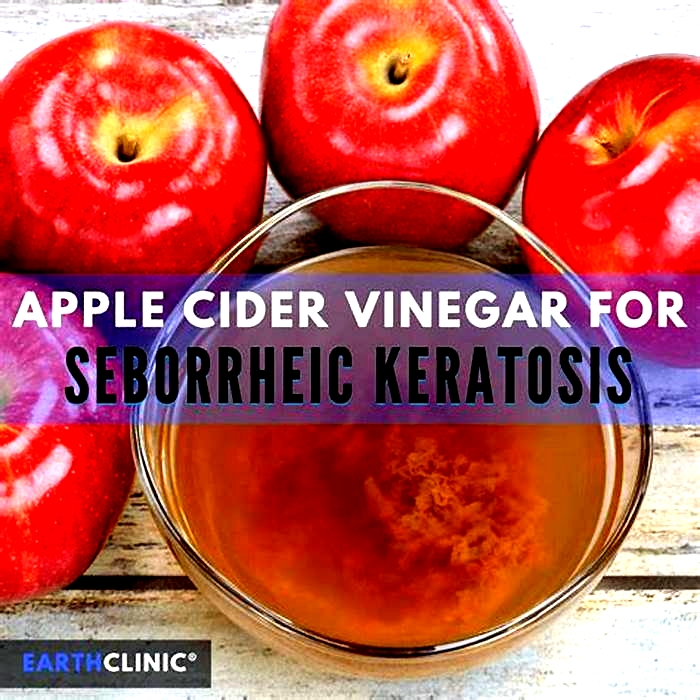 Is apple cider vinegar good for seborrheic dermatitis