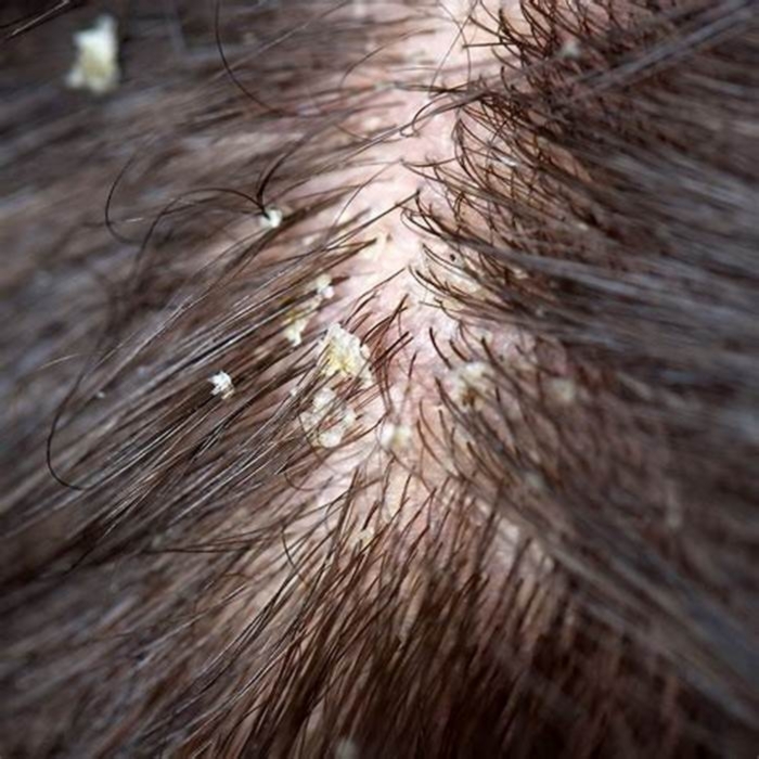 Is seborrhea a dandruff?