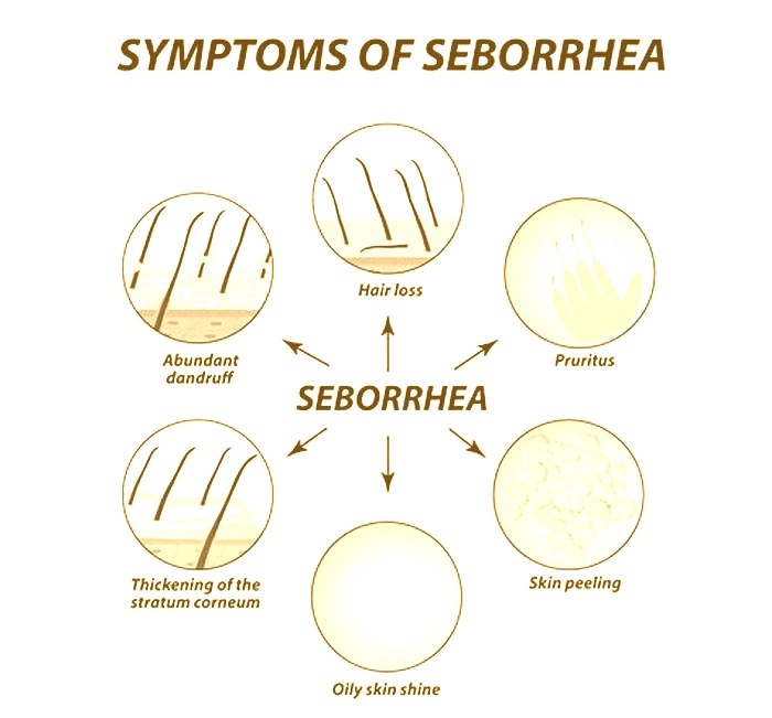 Is seborrhea itchy?