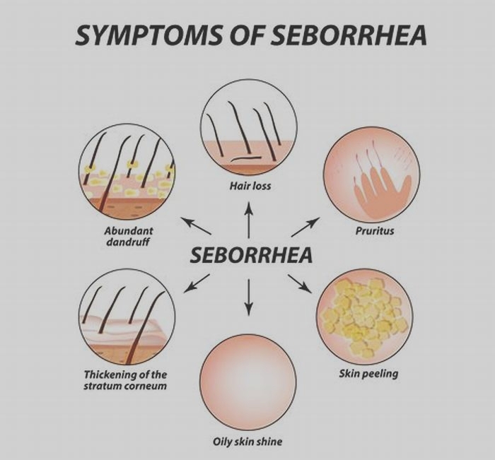 Is seborrhea serious?