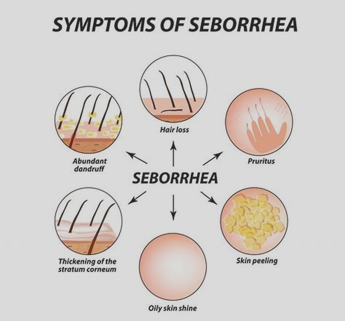 Is seborrheic dermatitis a fungus?