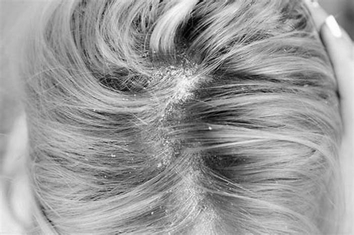 Is seborrheic dermatitis worse than dandruff?