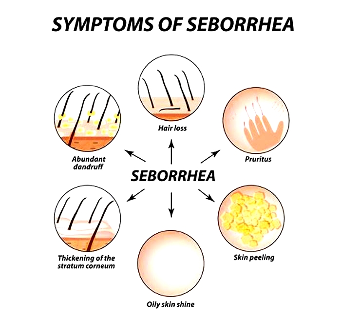 What can be mistaken for seborrheic dermatitis