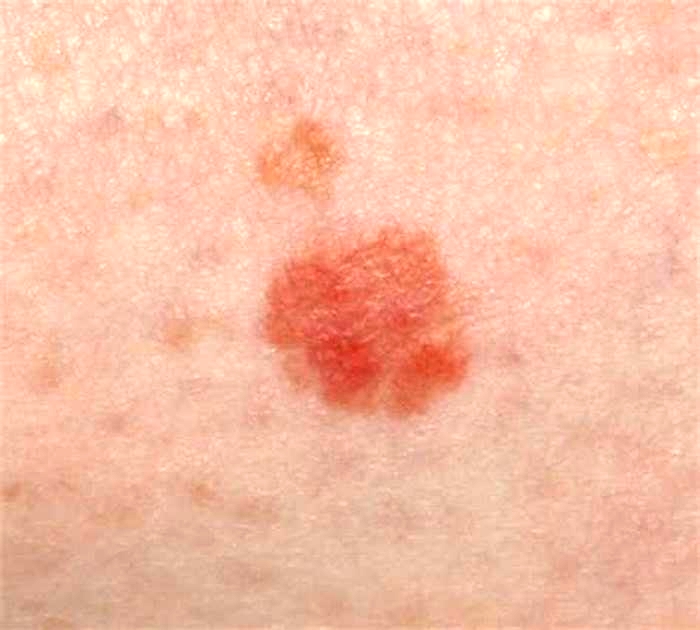 What does a cancerous rash look like?