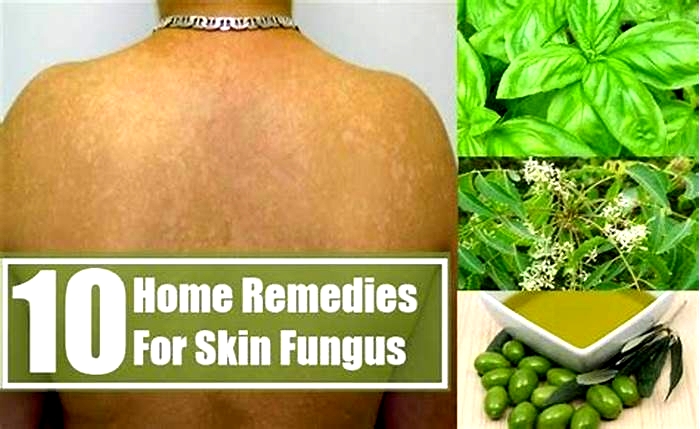 What kills skin fungus fast